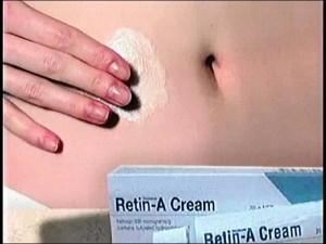 stretchmarks