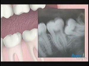 wisdom teeth 2