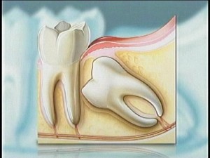 wisdom teeth